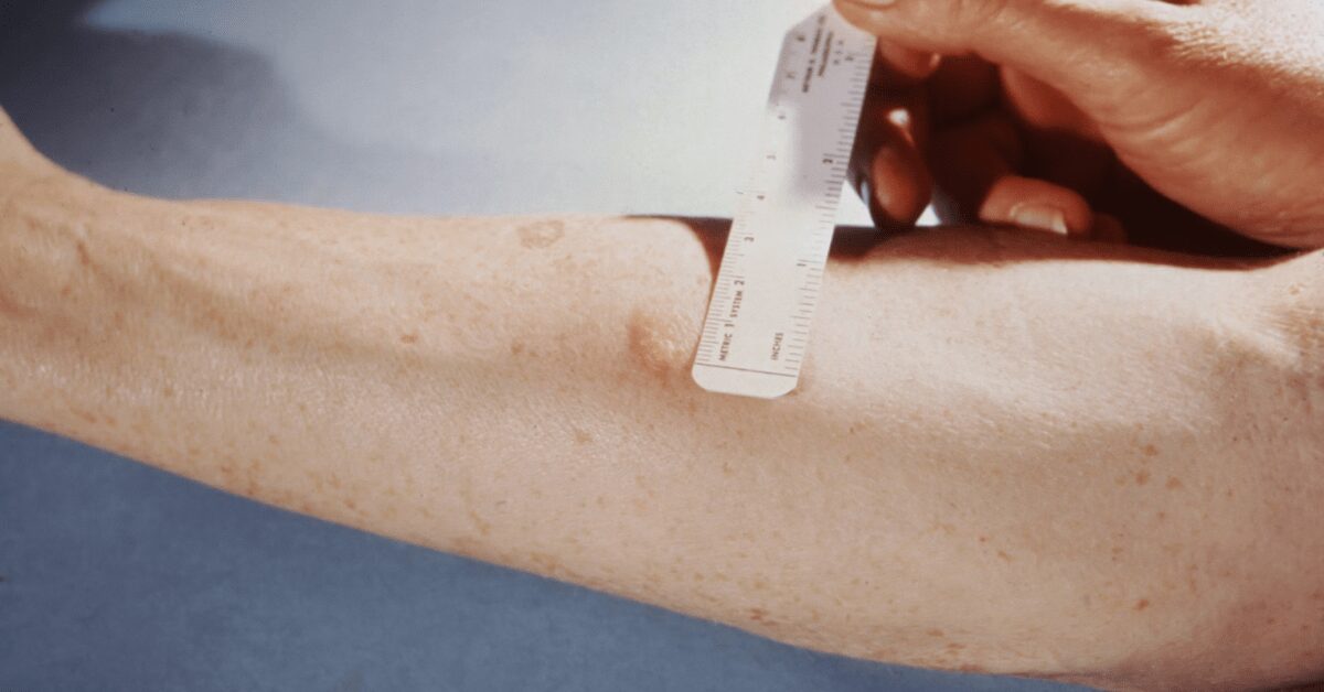 How Can I Get a Blood Test Without a GP Referral?